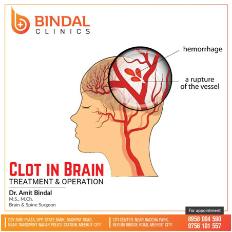 Treatment of clot in brain at Bindal clinics, Meerut Treatment of clot in brain at Bindal clinics, Meerut