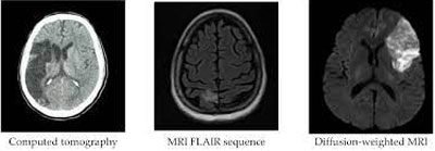 Ischemic stroke Ischemic stroke