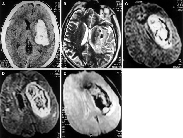Hemorrhagic stroke Hemorrhagic stroke