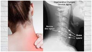 Cervical pain or neck pain