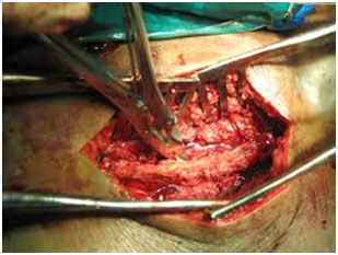 Open surgery large incision