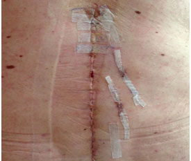 Open approach big scar